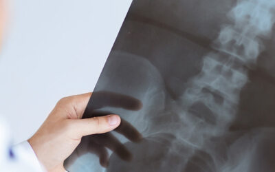 Spinal Cord Injury Story